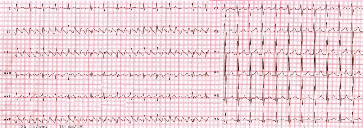 Вот такая "пила" на ЭКГ - характернейший признак трепетания предсердий, когда электрический импульс бегает по предсердиям со скоростью порядка 300 оборотов в минуту
