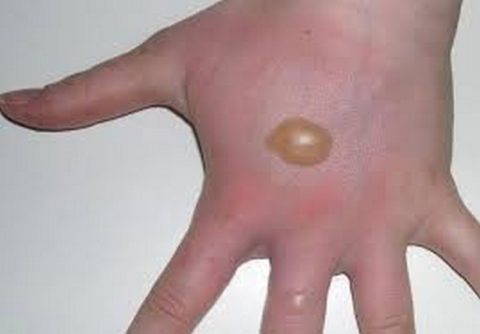  Препараты на мазевой основе активно используют для лечения термических повреждений с волдырями.