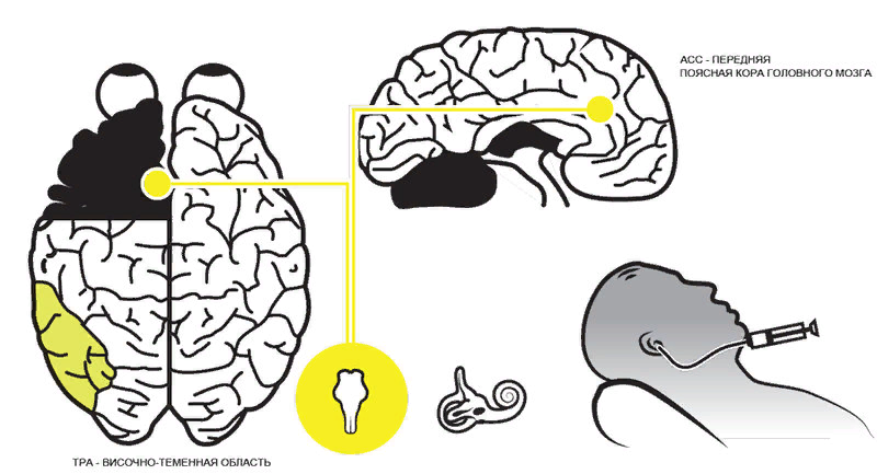 Промывание слухового канала — давний прием, хорошо известный неврологам под названием «калорическая проба». Голова пациента откинута назад под определенным углом, в наружный слуховой проход через гибкую трубку постепенно подается порядка 20 мл воды, которая затем выливается обратно. В зависимости от выбранной температуры вода приводит к охлаждению либо нагреванию жидких сред внутреннего уха, что вызывает конвекционное перемещение эндолимфы в горизонтальном полукружном канале, раздражая его рецепторы. Обычно эту пробу используют для диагностики вестибулярного аппарата (ее английское название — Caloric vestibular stimulation, CVS). Однако потенциал этой процедуры гораздо выше. Специалисты обнаружили, что она стимулирует отдельные зоны мозга и позволяет воздействовать на когнитивные и психологические состояния человека.
