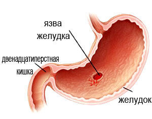   По статистике, от заболевания язвой желудка, в России страдают около 3-х миллионов человек.