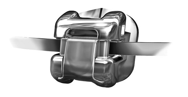 Наличие фиксирующего механизма Spin Tek сокращает общую длительность лечения на 25 %.
При использовании самолигирующих брекетов Damon нет необходимости в столь частом посещении врача, как при коррекции с применением классических лигатурных систем