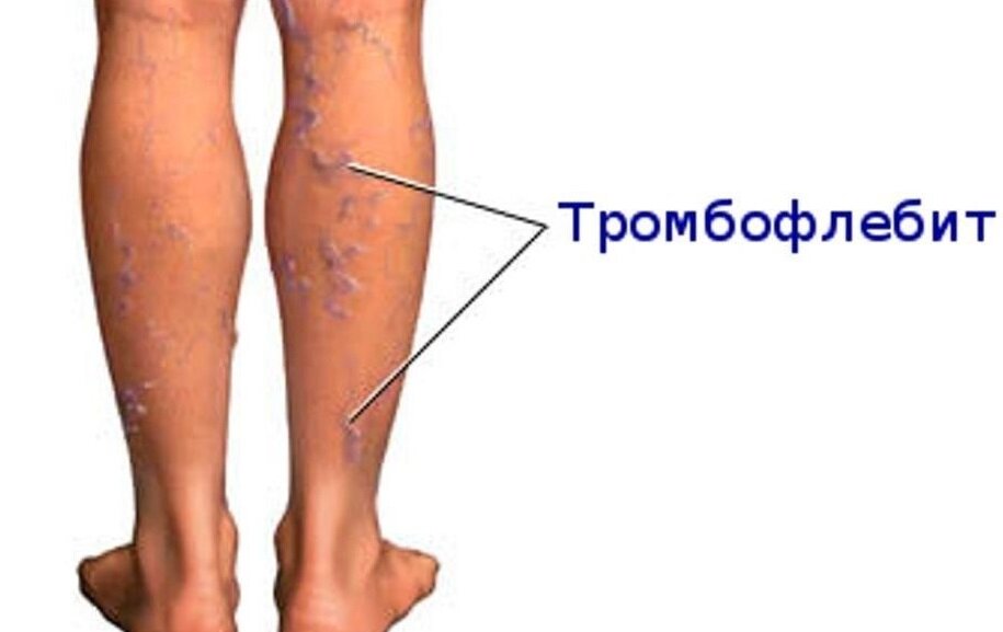 В большинстве случаев глубокий тромбофлебит появляется в вене ног,а особенно в голени, реже может возникнуть в венах на руках. Боль в икрах, когда вы сгибаете ногу, является возможным симптомом этого заболевания.
