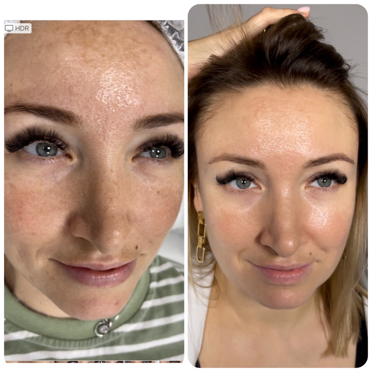 В лечении дисхромии кожи важно не только избавление от гиперпигментации – при правильном проведении процедуры кожа обретает здоровый вид и сияние.
Перед вами пример того, как выглядит уровень современной качественной медицинской косметологии! Никакой реабилитации, никаких химических пилингов и шлифовок, при этом пигментация практически исчезла, поры сузились, воспаление (акне) больше не беспокоит. И обратите особое внимание на то, как преобразилась кожа – полное впечатление, что пациентке снова 18 лет! На днях ее даже заподозрили в обладании чужим паспортом при прохождении таможни – контролеры отказывались верить, что перед ними тот же человек, что на фотографии в документе!