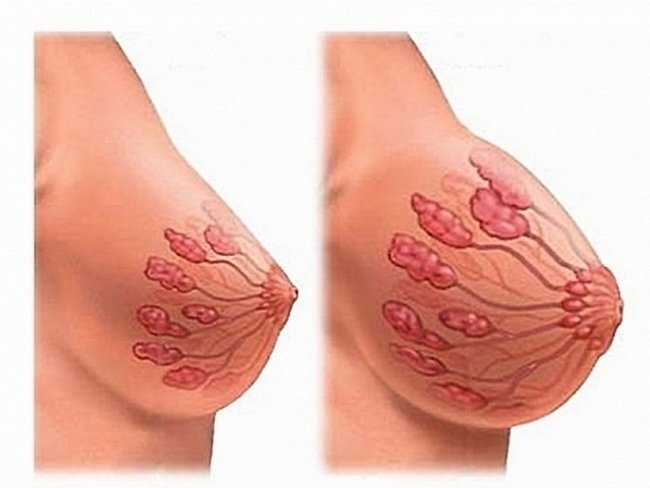 Как подтянуть женскую грудь хирургическим путем