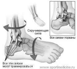 Растяжение мышц и сухожилий: лечение и симптомы