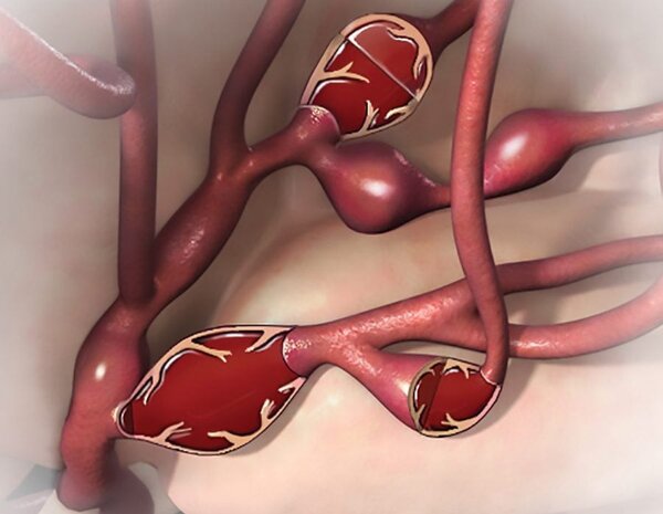 Иллюстрация атеросклеротического поражения сосудов