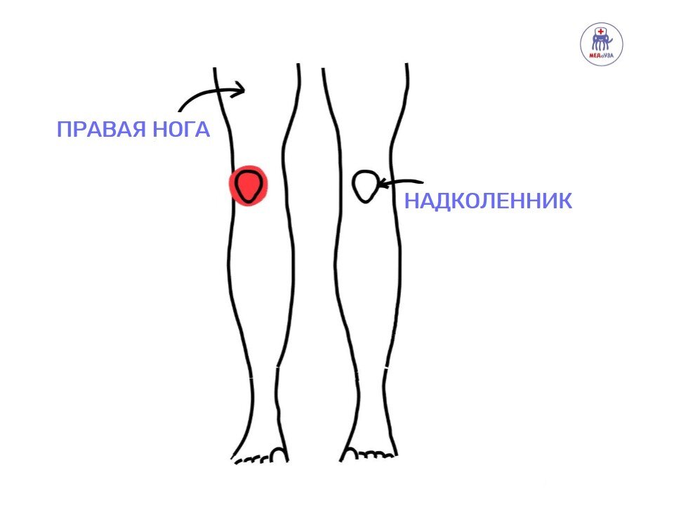 Смысл «колена бегуна» в том, что надколенник смещается наружу. В правом коленном суставе - вправо, а в левом – влево.