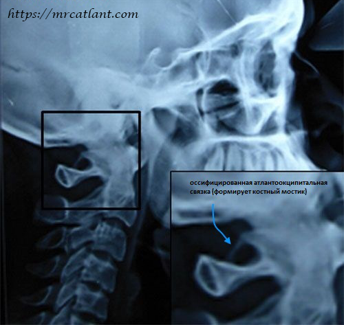 Кимерли аномалия в шейном отделе. Аномалия Киммерли в шейном отделе позвоночника рентген. Рентген шейного отдела аномалия Киммерли. Аномалия Киммерле неполная рентген.