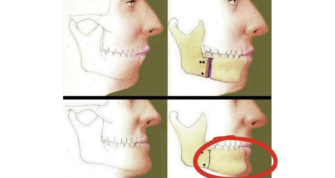 Брекеты исправляют прикус. Привкус после операции. Привкус после операции. Операция на челюсть для исправления прикуса. Мезиальный прикус и внчс.