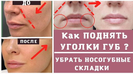 Поднять уголки губ тейпами схема