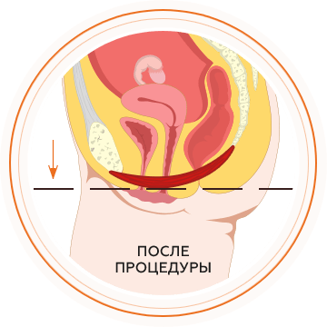 Подтяжка тазового дна в Набережных челнах.