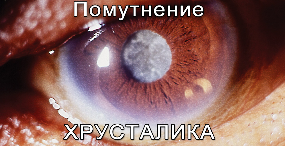 помутнение хрусталика