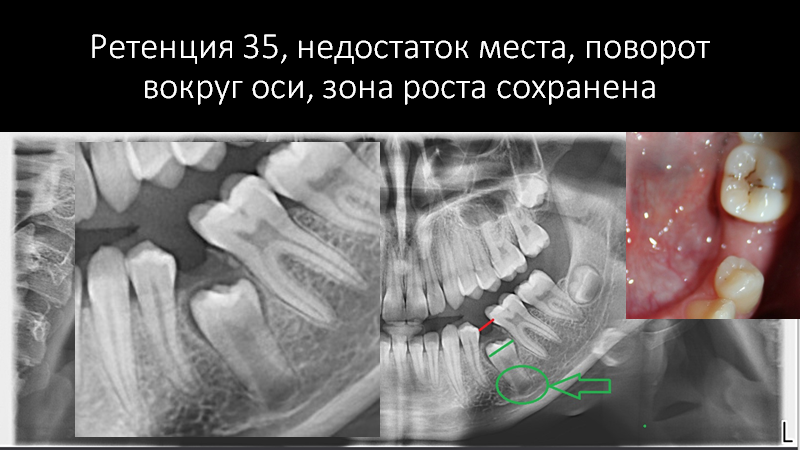 В полости рта зуб отсутствует, а на рентген-снимке есть