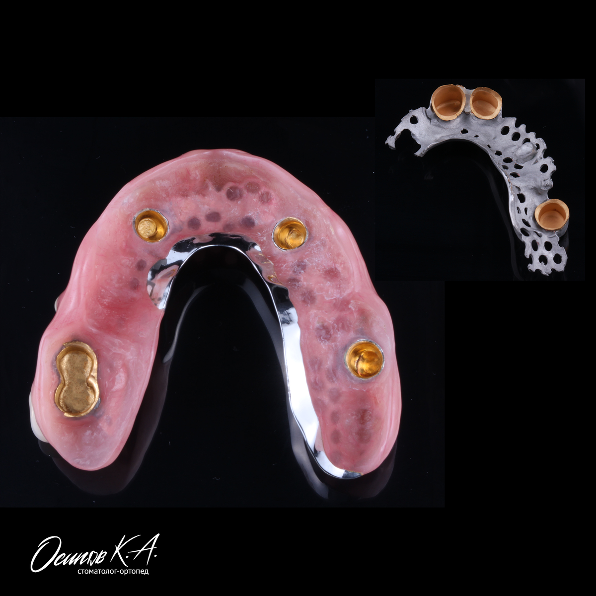 Новый протез и оставшаяся часть старого, которая не была интегрирована в новый