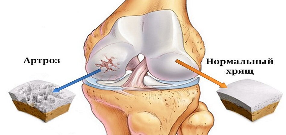 Эффективное лечение артроза колена без операции!
