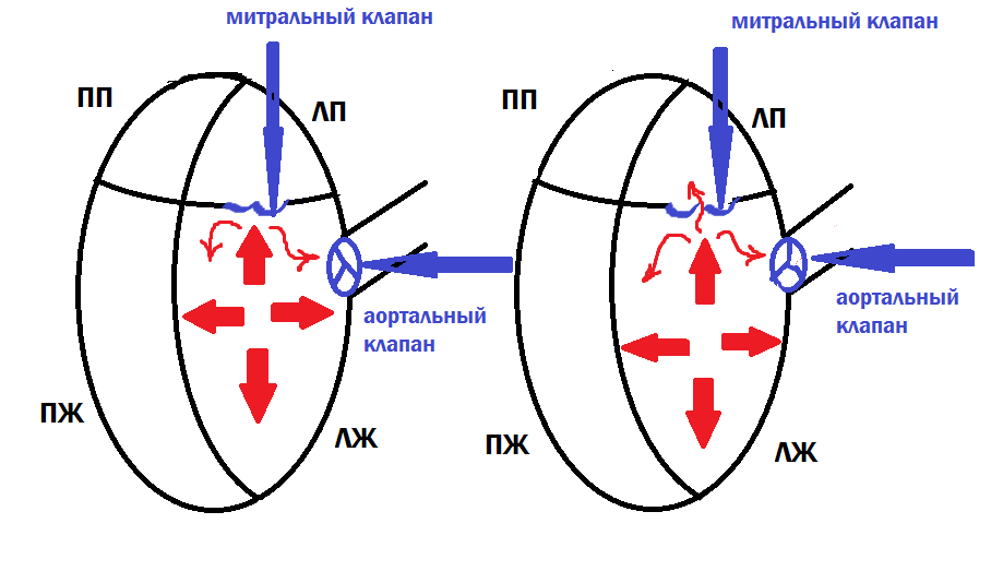 Слева: норма. Справа: неплотное смыкание створок митрального клапана, приводящее к регургитации. ПП: правое предсердие; ЛП: левое предсердие; ПЖ: правый желудочек; ЛЖ: левый желудочек. 