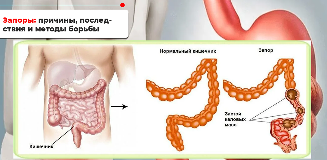 Почему начался запор