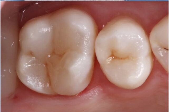 Пример анатомически правильной реставрации зуба