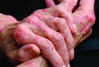 Экзема является распространенным кожным заболеванием, которое характеризуется воспалением кожи и появлением на ней мелких пузырьков, сливающихся в крупные очаги поражения. На месте лопнувших пузырьков образуются пузырьки, которые подсыхают и покрываются зудящей коркой. При длительном течении заболевания пораженная кожа становится более грубой и плотной, более того, появляется угроза присоединения серьезной бактериальной инфекции. Экзема чаще всего носит сезонный характер и обостряется в осенне-зимний период.