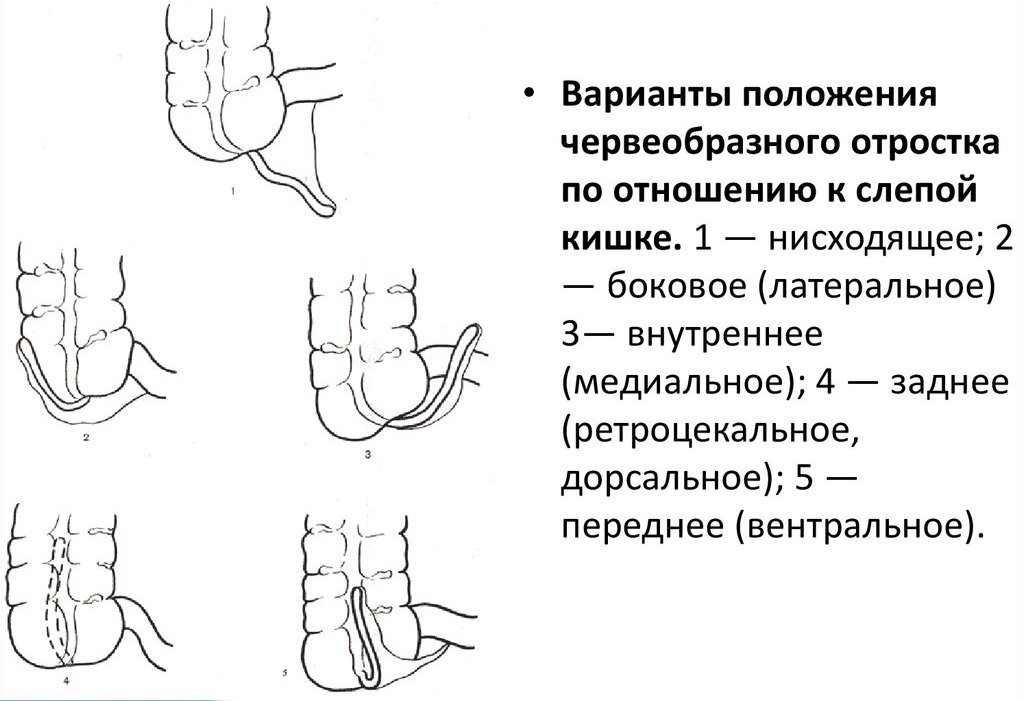 Аппендикс расположение схема