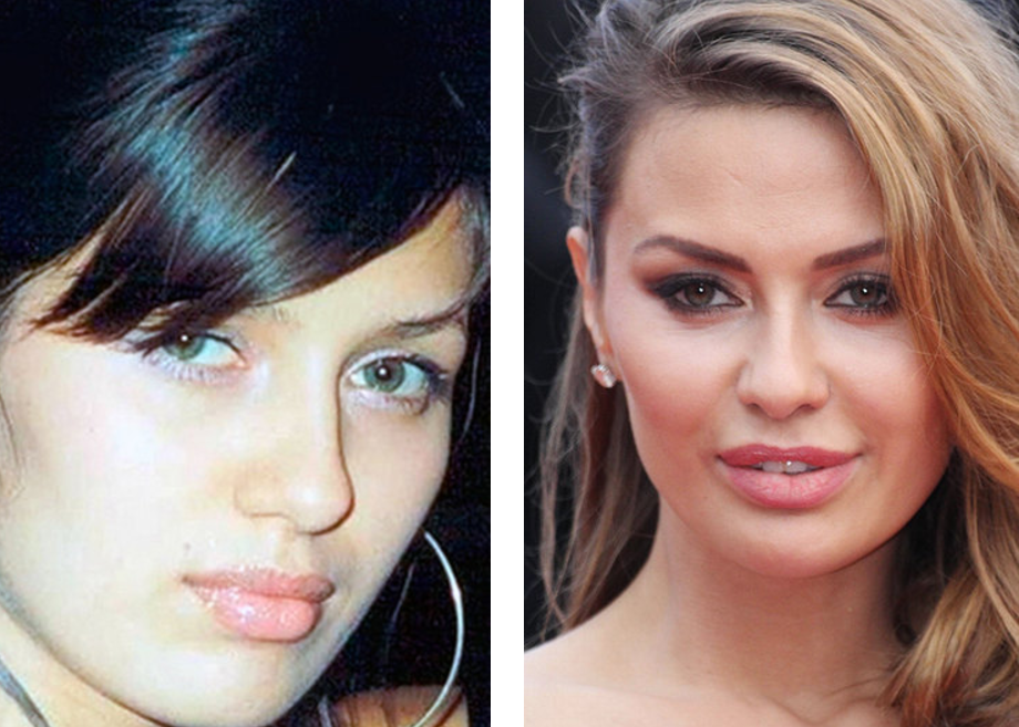 Дибров пластика до и после фото лица