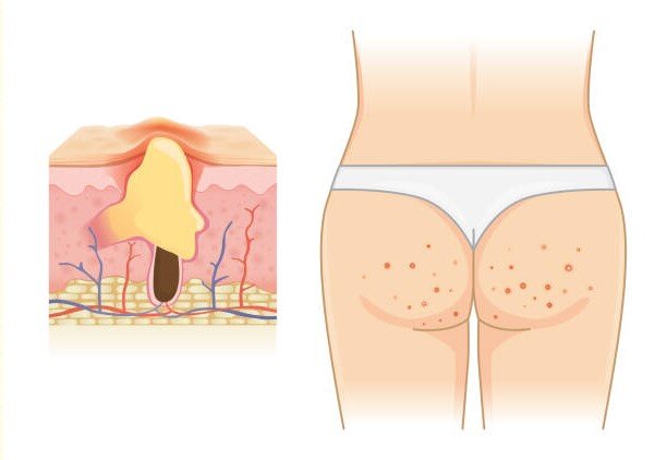 Прыщи на попе: почему появляются и что с ними делать