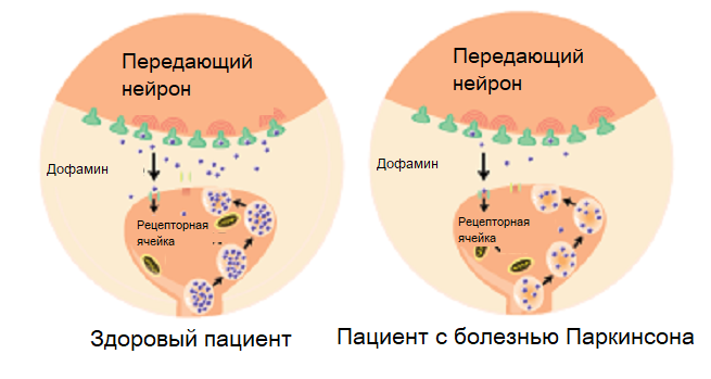 Сколько живут с болезнью Паркинсона и ее классификация. | Нервы в ...