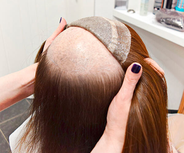 Система замещения волос на сетке. Фото yandex.ru