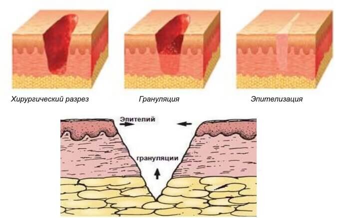 Образование рубцовой ткани