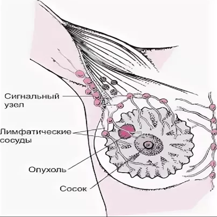 сигнальный лимфоузел. сигнальный лимфоузел. биопсия сигнальных лимфоузлов. показания к биопсии лимфатических узлов. сигнальный лимфоузел.