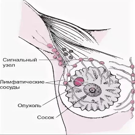Лимфоузлы молочной железы расположение у женщин фото и описание
