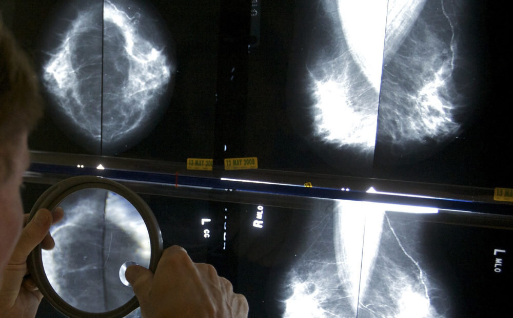 МАММОГРАФИЯ С ПРИЦЕЛОМ. Все ли «видит» исследование, которое считается ...