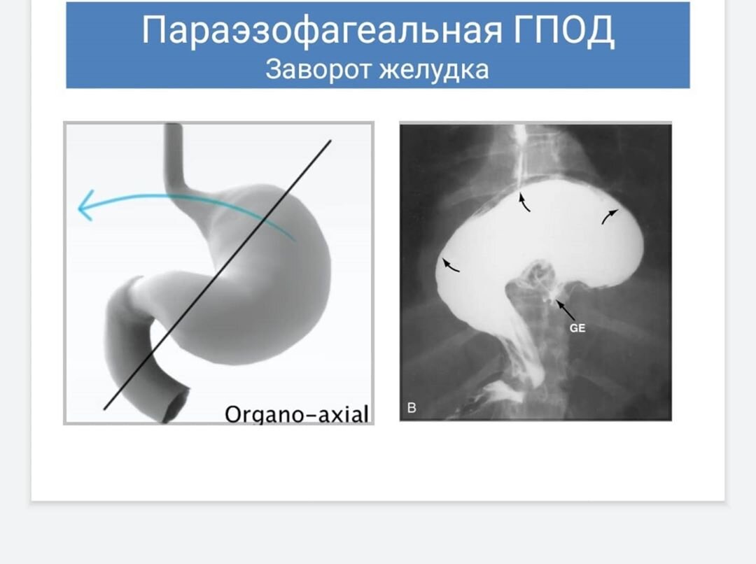 Грыжа пищеводного отверстия диафрагмы. Рефлюкс-эзофагит.(Информация для  пациента.) | Торакальная хирургия МОНИКИ | Дзен