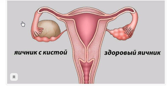 Киста яичника: причины появления, симптомы, методы диагностики и лечения