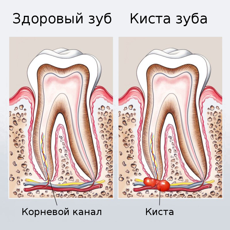 Киста зуба симптомы и признаки фото лечение