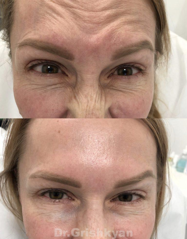 Dermal Injectables - Botox, Juvederm, Radiesse, Sculptra - YouTube