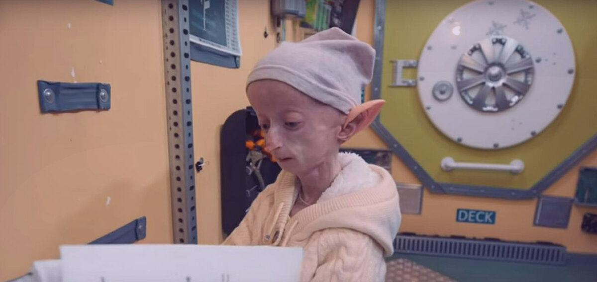 Девочка Аня с прогерией