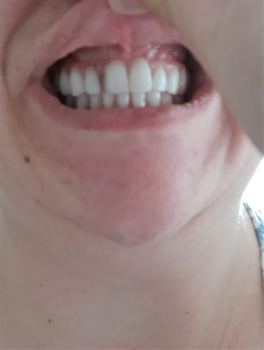 Очень маленькая площадь искусственной десны!!! Супер! Еще раз прошу прощение за качество фото.