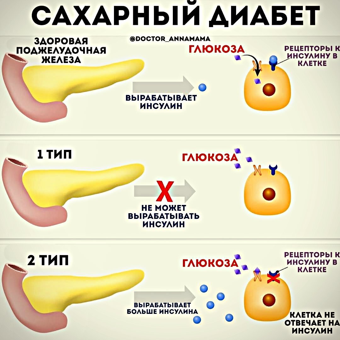 Какой бывает диабет типы