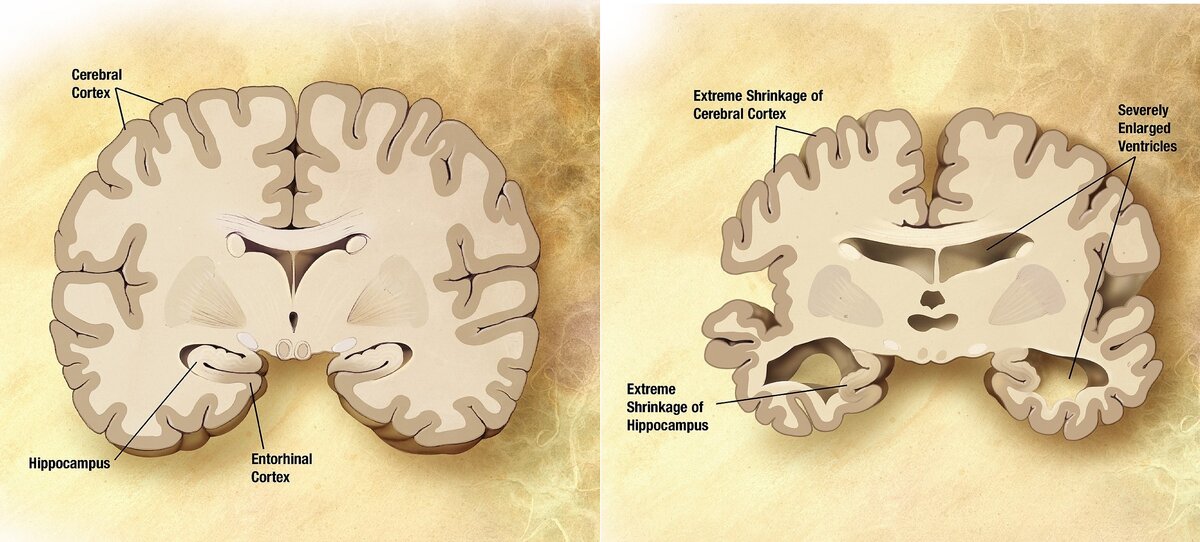 File:Alzheimer's disease brain comparison.jpg медиафайлы на Викискладе