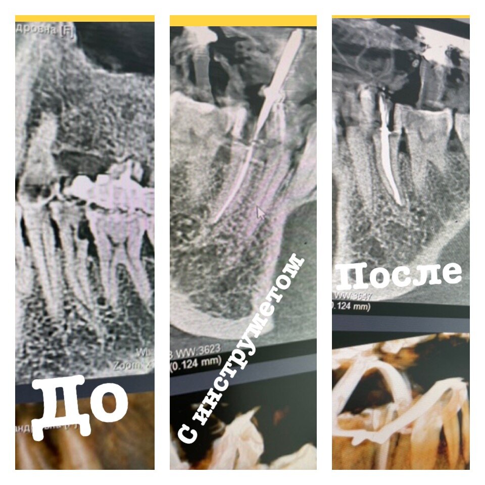 Лечение корневого канала 45 зуба “. | Врач стоматолог/Владимир | Дзен