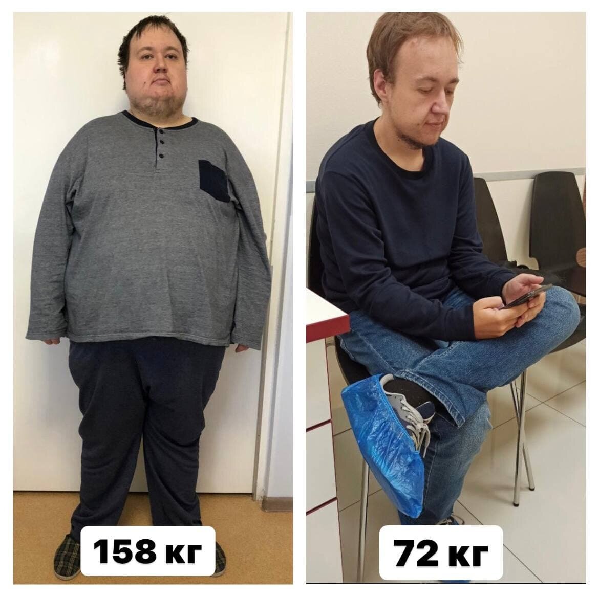 
До.
На фото Антон, 28 лет. 158 кг.
Сидячий, малоподвижный образ жизни.
Престижная работа в IT сфере. Home office. Снеки по рукой. Представили?

Маленький нюанс. Отвлечемся на секунду. Как мы сидим за компьютером, а еще если долгое время?

Наверняка не с выпрямленной спиной и двумя ногами на полу, как учили в школе?)

А как попало. Нога но ногу, скрестив коленки, или вообще задрав ноги на стул «по-турецки».

Когда вес большой сесть так очень сложно. Даже невозможно. #задумайтесь
Качество жизни проявляется в таких мелочах.
К такому дискомфорту присоединились сопутствующие заболевания.

Прооперировались. Все прошло отлично.
Через 17 месяцев, Антон пришел на прием, свободно сел закинув одну ногу на коленку. Смотрите на фото.

Вес 72 кг. Минус 86 кг!

Это большой результат!

Я увидел это, и у меня в голове сразу вспомнилась история, о том, как мы с ним как раз перед операцией обсуждали, что такие мелочи, как просто удобно сидеть за компьютером целый день, для человека с большим весом просто невозможны.

В этом момент я попросил разрешение сделать фото.

На мой взгляд это очень символично. Как считаете?

*все фото и видео материалы используются исключительно с согласия пациента на публикацию