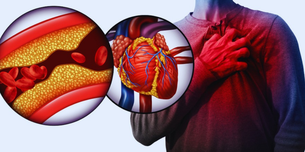 Причиной ОКС №1 является атеросклероз. Нарушается поток крови к  сердечной мышце.