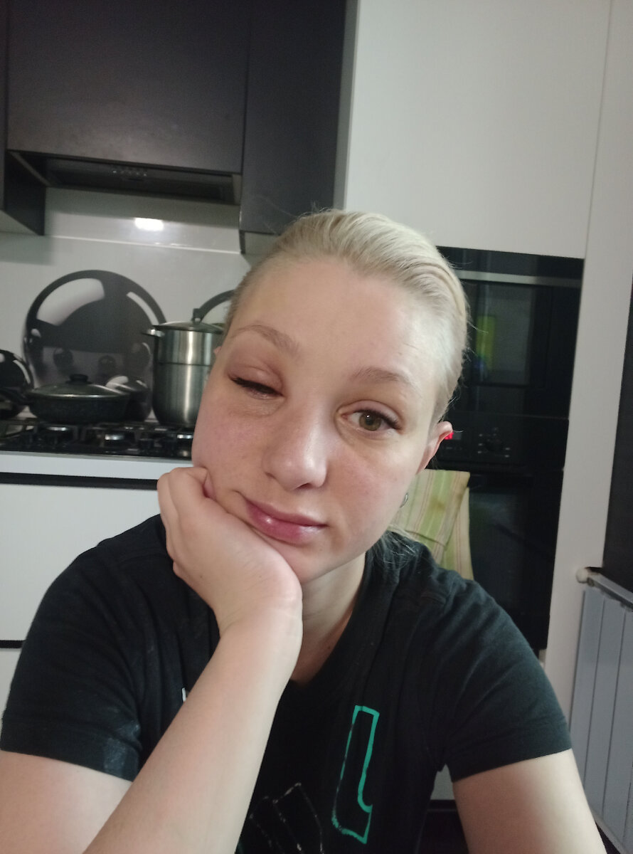 На одном глазу отёк слабый, а второй, думаю, и комментировать нечего🙈😂