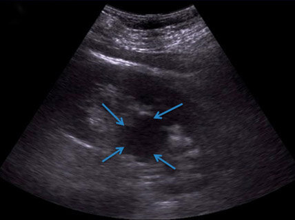 УЗИ почек. Обнаруживает округлое образование, которое локализуется в паренхиме органа или экстраренально.