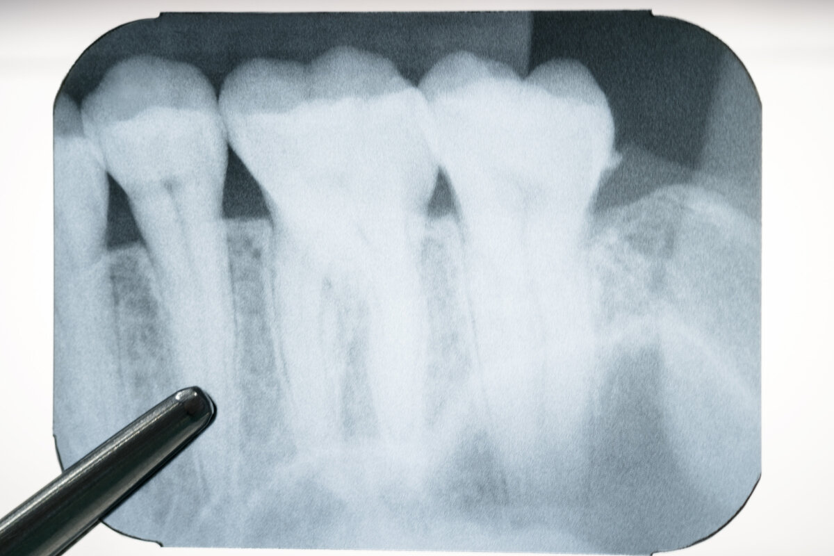 Виды рентгена в стоматологии - какие бывают? | Портал о зубах Симпладент |  Дзен