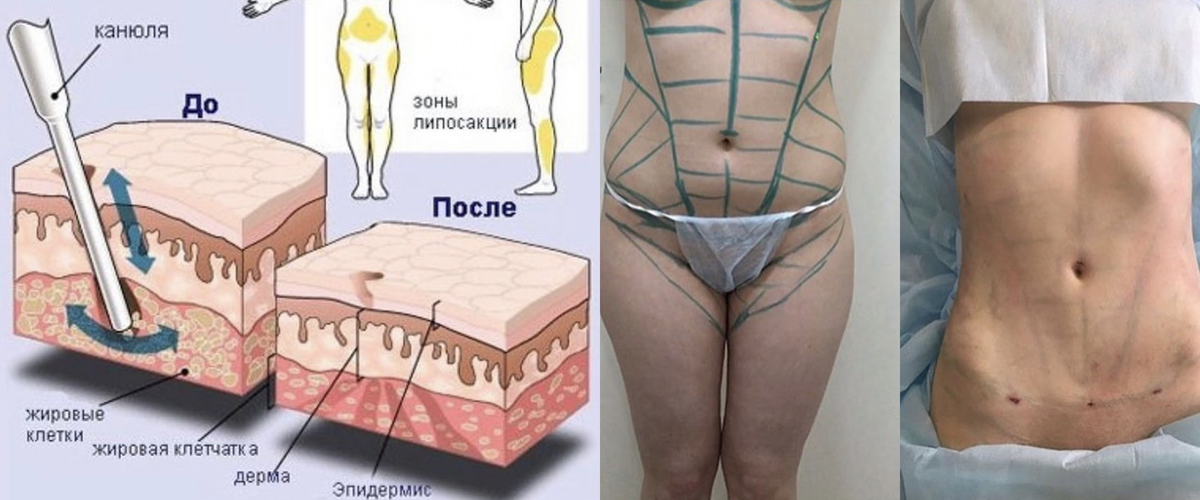 Зоны липосакции на теле схема