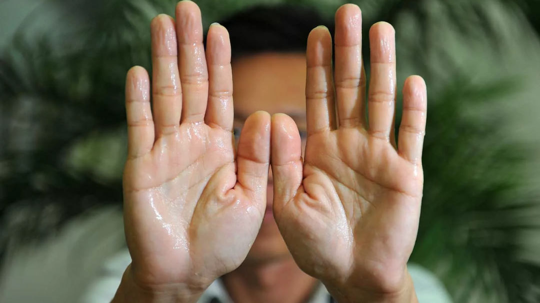 почему потеют ладошки рук