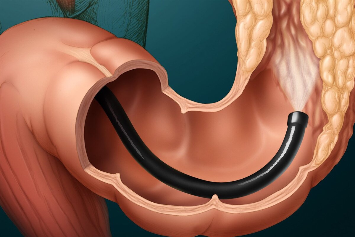 Эндоскопическое исследование толстой кишки колоноскопия