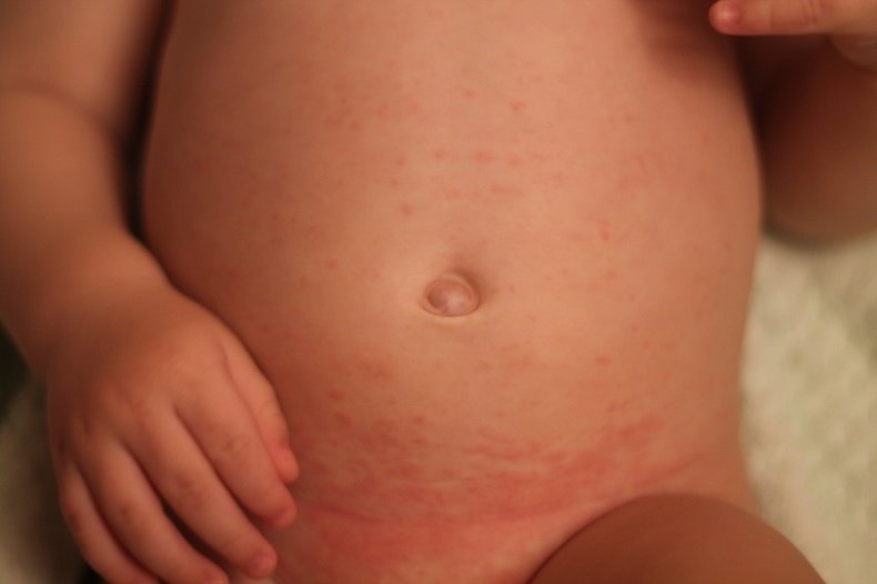 Как может проявляться пеленочный дерматит